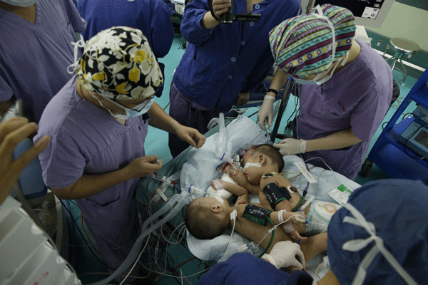 Conjoined girls separated in surgery