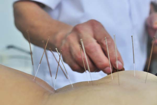 'Sharpen up' acupuncture study