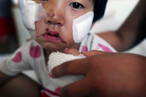 Girl mauled by mastiff needs 200,000 yuan for surgery
