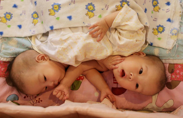 Conjoined babies waiting for surgery