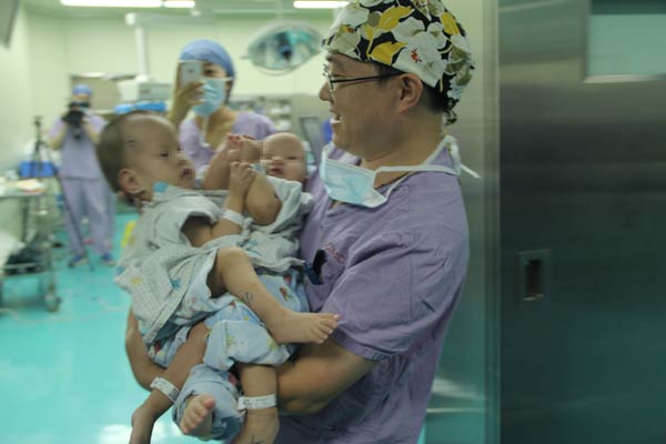 Conjoined twins separated in Shanghai