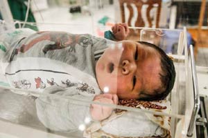 Conjoined twins separated in Shanghai