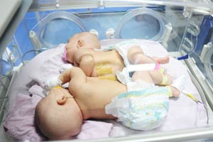 Conjoined twins separated in Shanghai