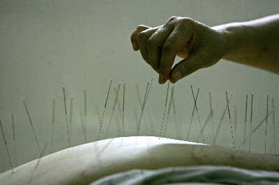 China's acupuncture carried out in Europe