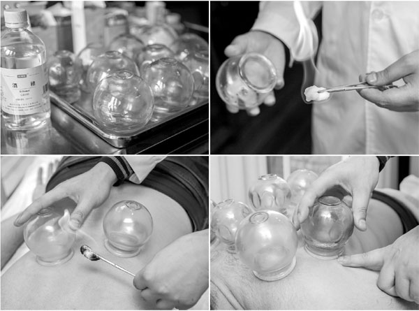 Cupping and coining: I did it long before Michael Phelps did in Rio