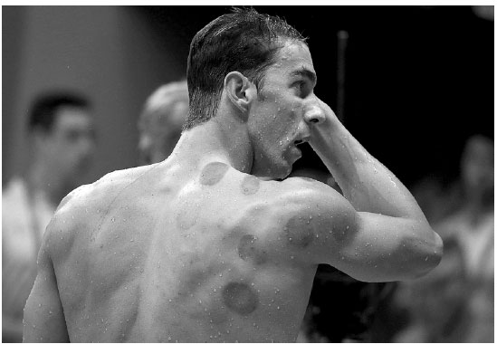 Cupping and coining: I did it long before Michael Phelps did in Rio