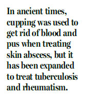 Cupping and coining: I did it long before Michael Phelps did in Rio