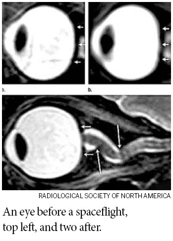 Squashed eyeballs are danger in space