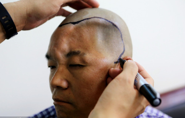 Man accepts a 3D-printed titanium half-skull