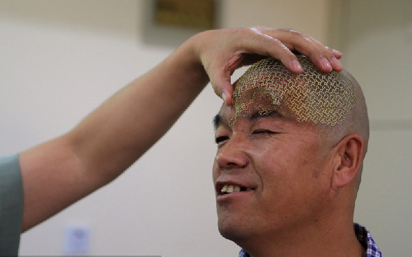 Man accepts a 3D-printed titanium half-skull