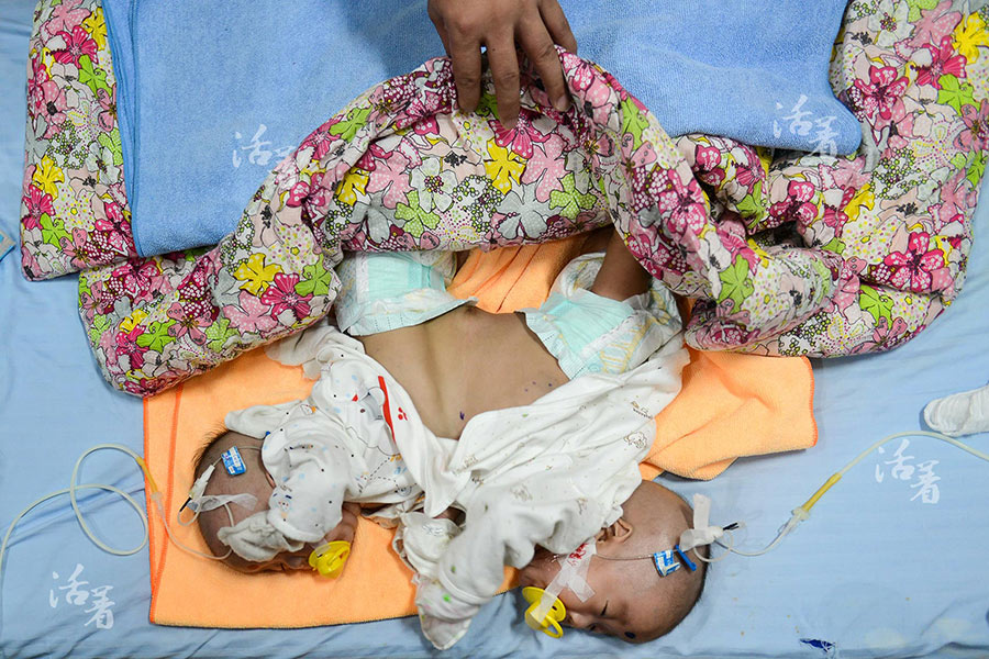 Conjoined twins' operation bittersweet for family