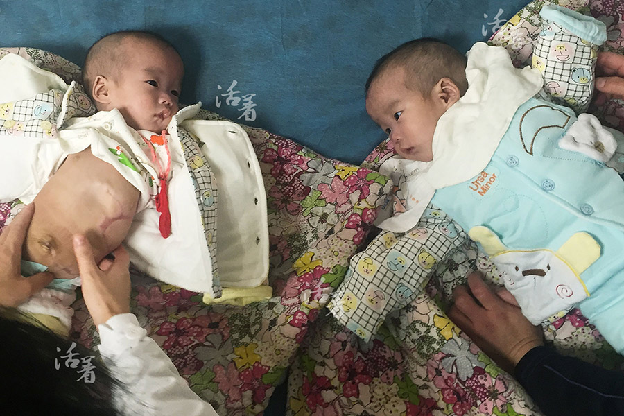 Conjoined twins' operation bittersweet for family