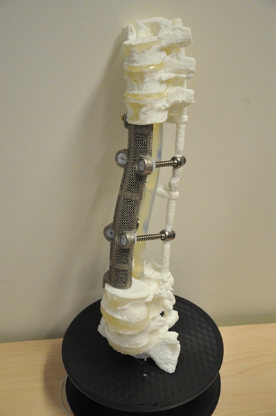 3D printer gives man a new spine
